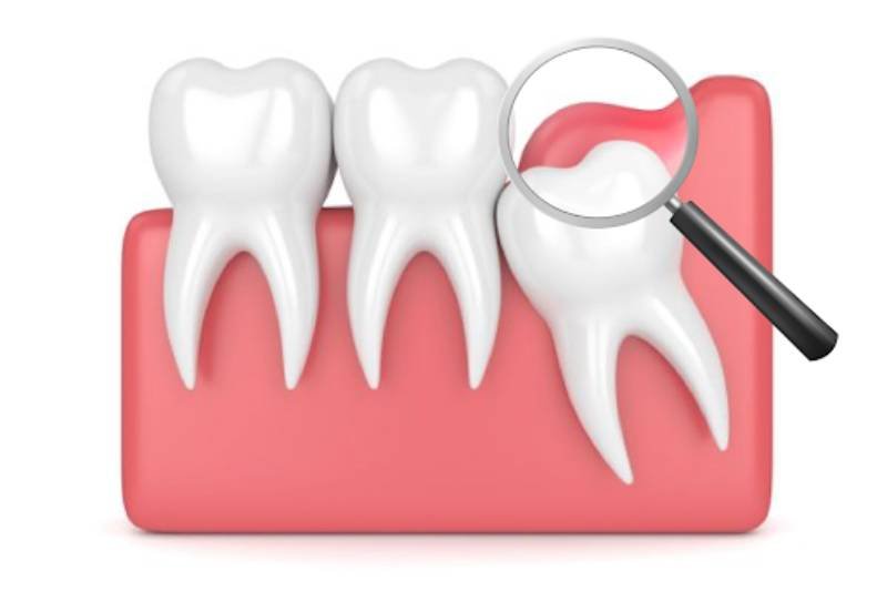 chi phí cắt lợi trùm giá bao nhiêu