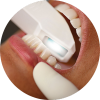 Bước 2: Sửa soạn răng - lấy dấu 3D răng