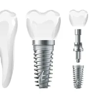 trongimplant trongimplant